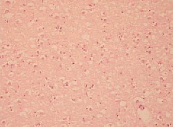 tejido infectado prion_2.gif